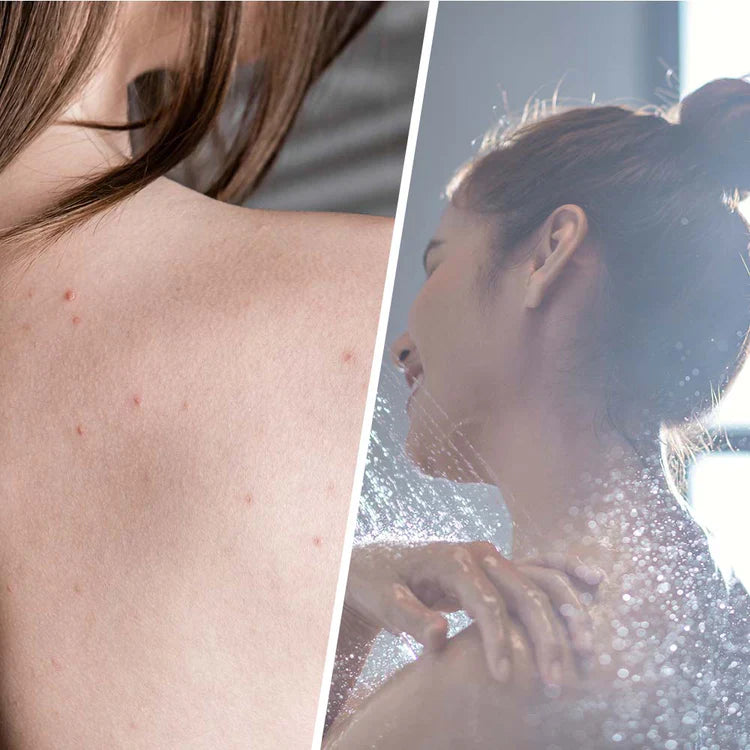 Salicilni piling s čajnim drevesom za razstrupljanje kože 250 ml